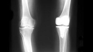 Рентген снимок ноги