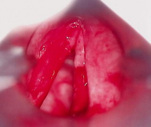 рак горла изнутри