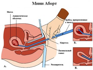 mini_abort1