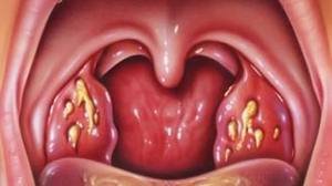 миндалины в горле