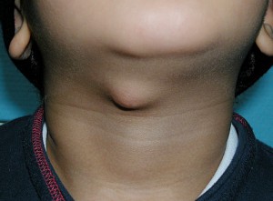 воспаление лимфоузлов на шее у детей