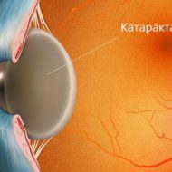 Классификация катаракты хрусталика